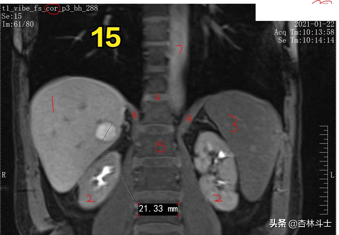 肝癌8公分肿瘤能活多久,肝癌细胞最大长多大