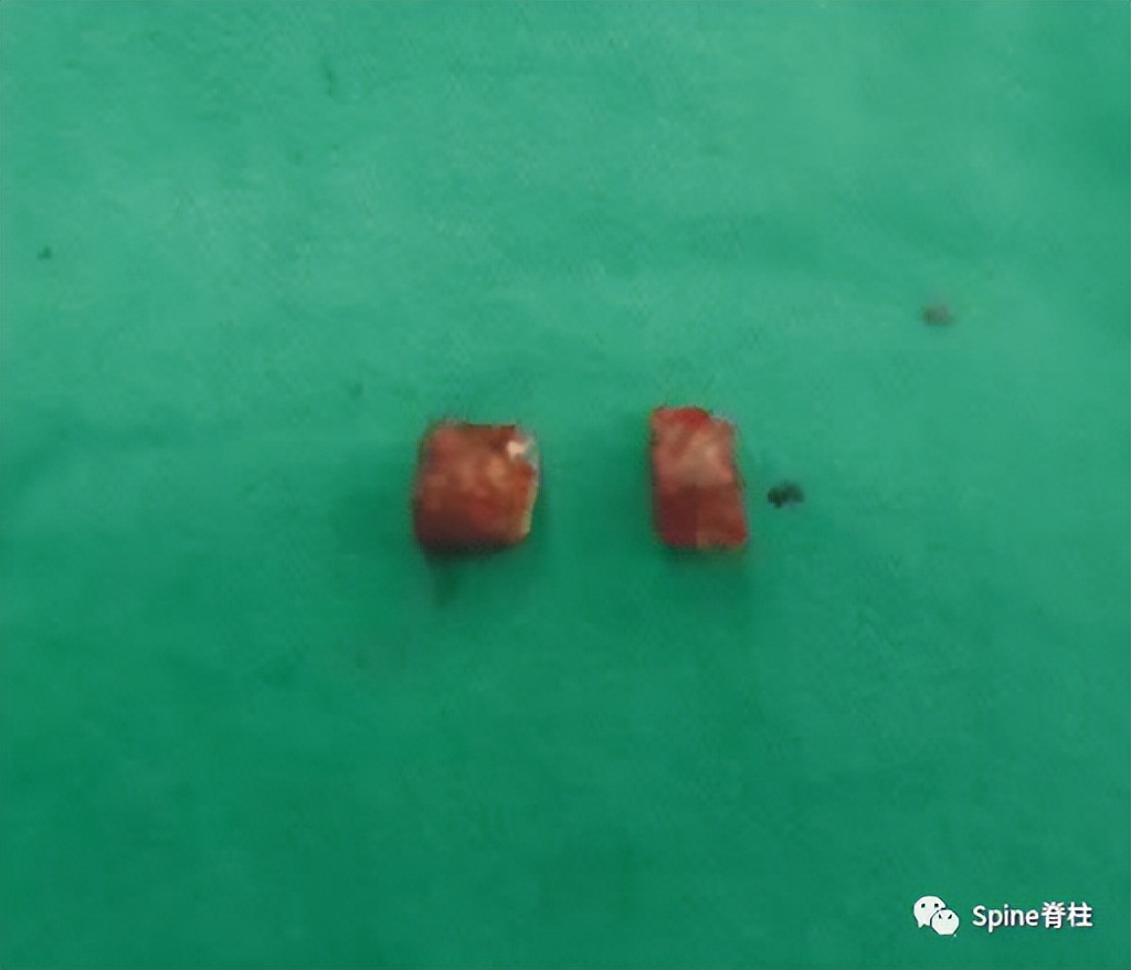 轻度峡部裂和重度峡部裂的区别,真性峡部裂和假性峡部裂