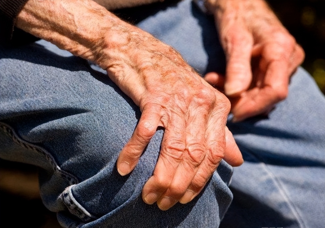 帕金森病的中医辨证与治疗,帕金森病可用中草药治吗