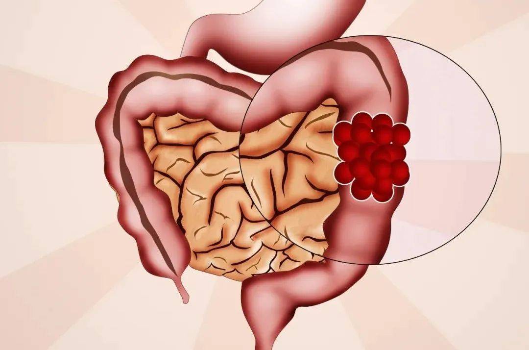 母亲癌症遗传下一代的概率,三种癌症遗传给下一代