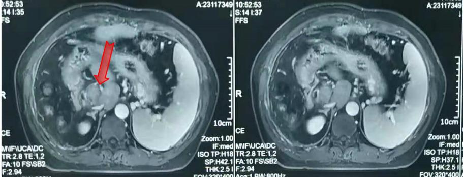 放疗肝内胆管细胞癌能治好吗,放疗治疗肝门静脉癌栓