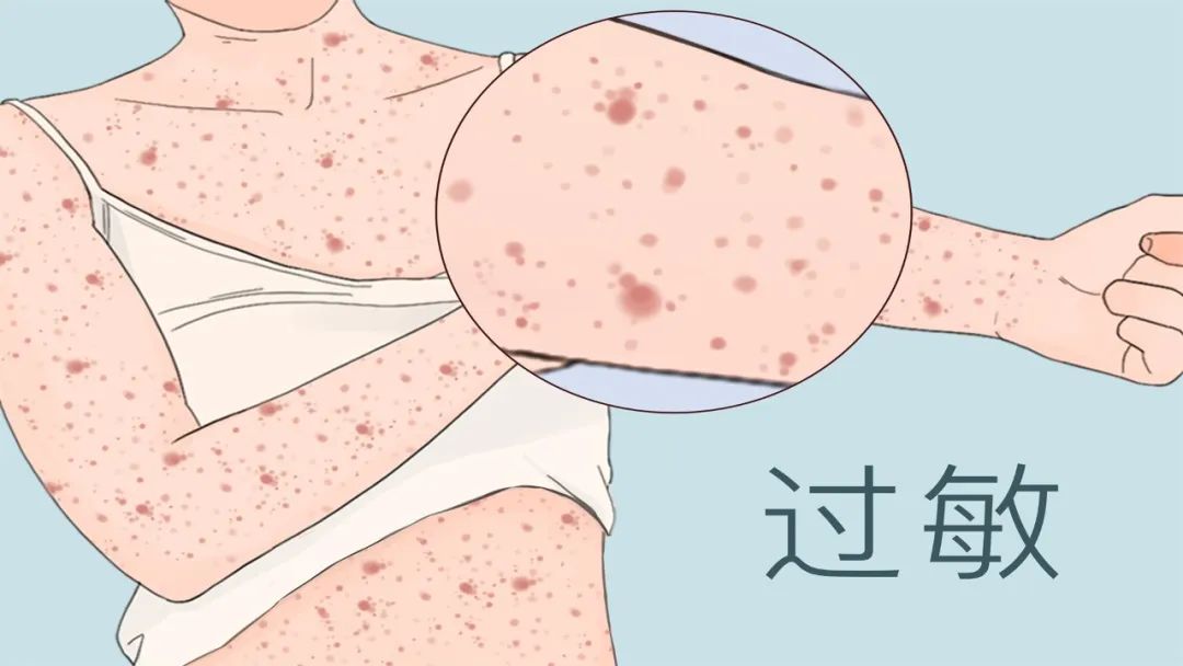 为啥有人对精液过敏?对精液过敏的女人,怎么生孩子?