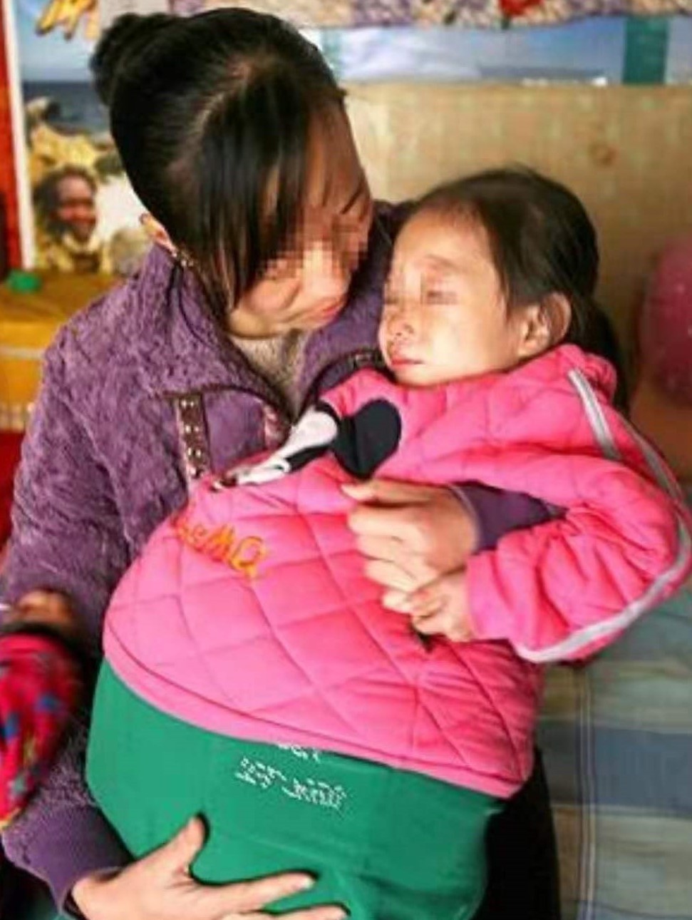 2010年一位山西4岁女童得“怪病”，肚子宽106厘米，后来治好了吗