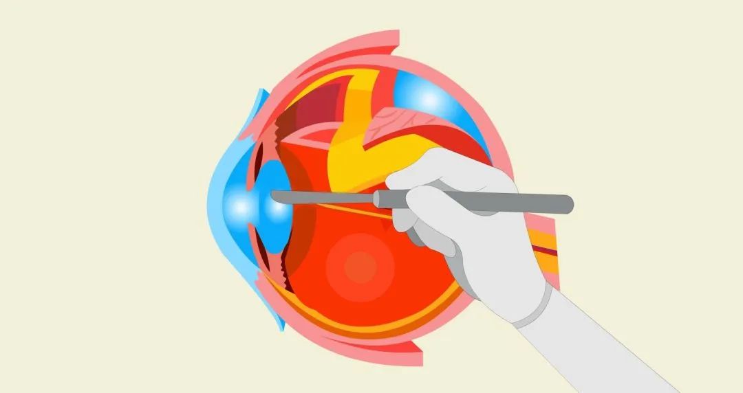 白内障久拖不治成弱视,白内障一直不做手术有什么后果