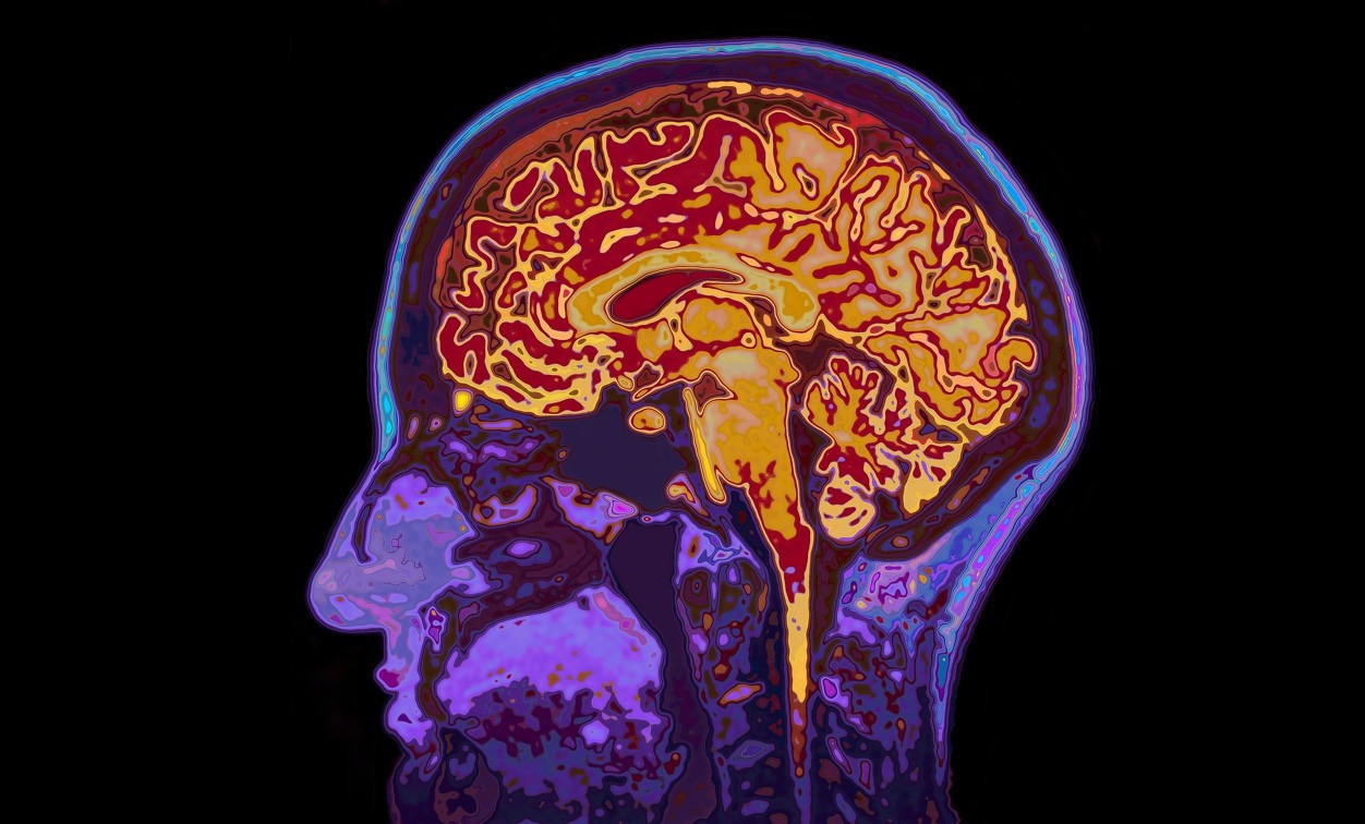 婴儿轻度脑积水是什么原因引起,新生儿轻微脑积水怎么治