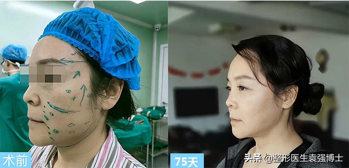 50岁女人看起来像三十岁吗,女人40岁应该做的医美项目