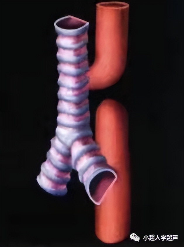 食道闭锁超声表现,食管闭锁一型手术过程