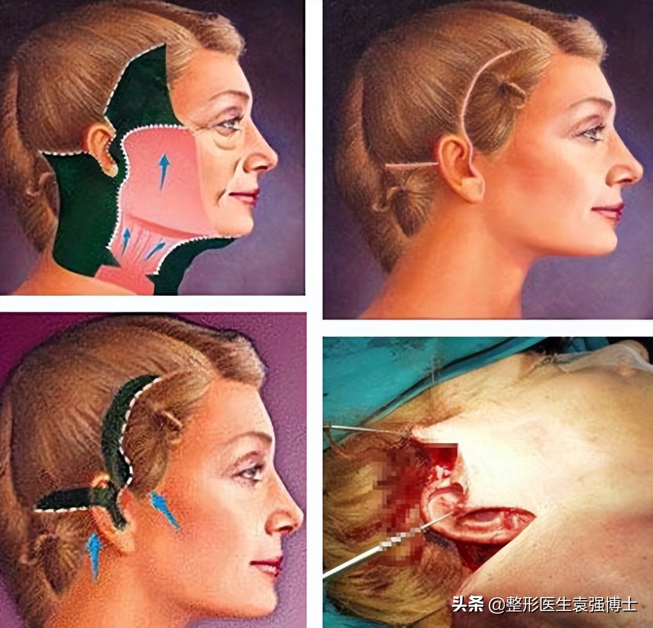 拉皮手术那么危险为什么还有人做,拉皮手术的真实感言