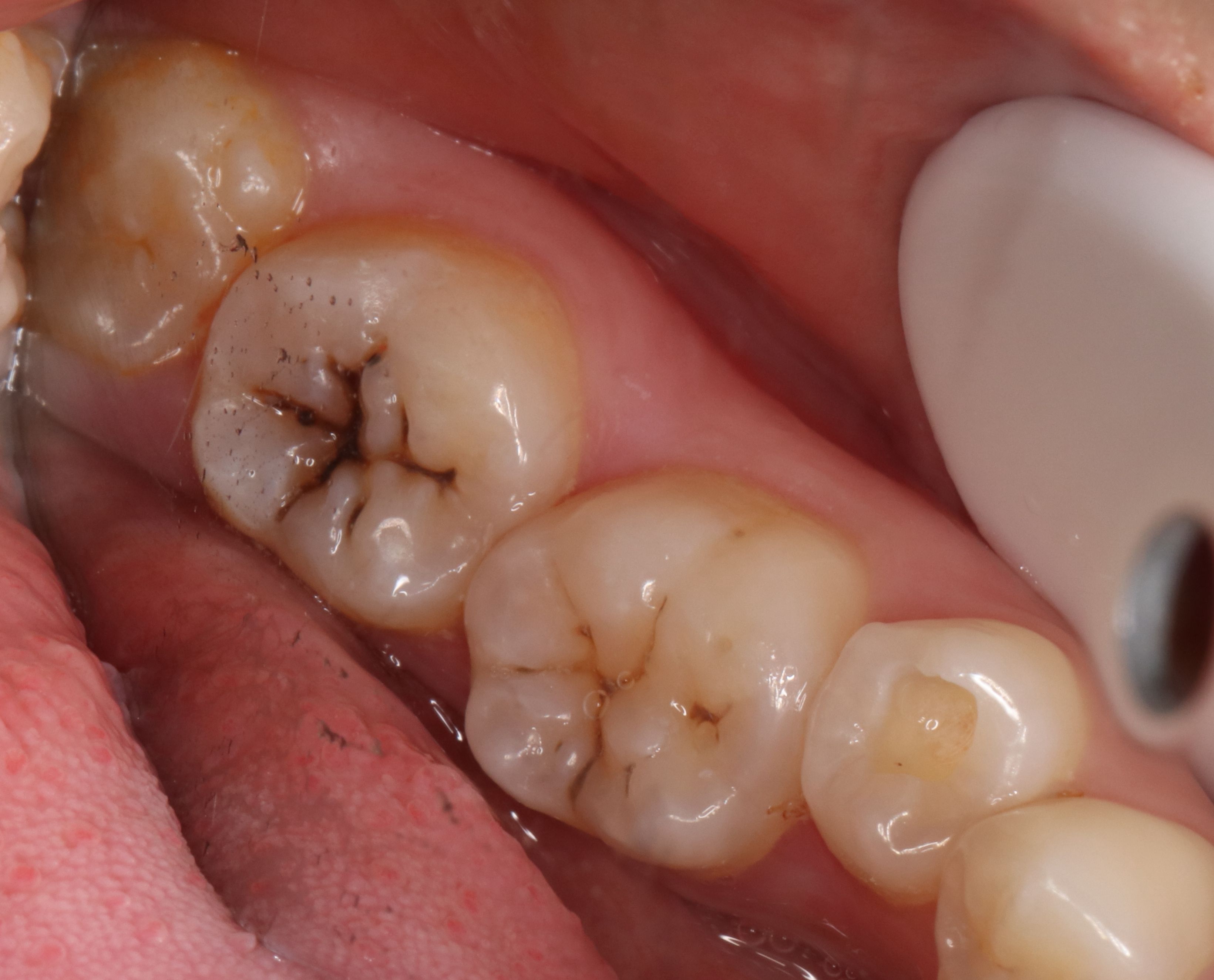 牙齿龋坏有什么严重后果吗,牙齿坏的危害