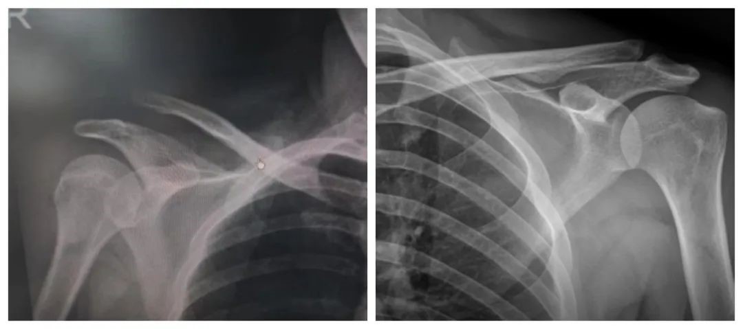 肩锁关节脱位秦皇岛市第一医院关节镜微创手术为患者解除痛苦