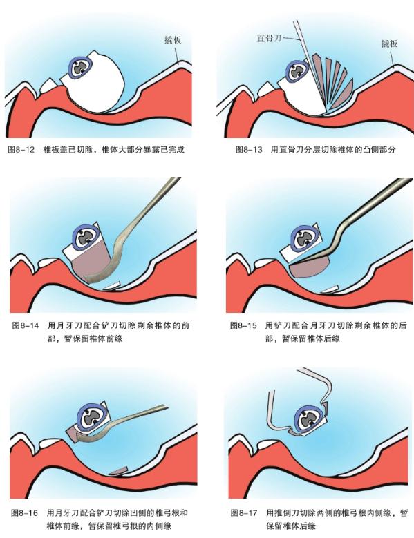 骨科基础：脊柱后侧凸截骨术