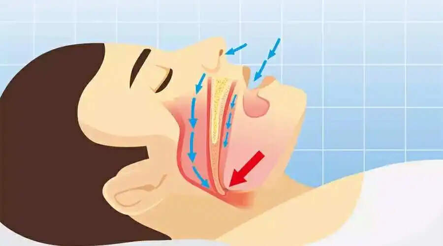 打鼾对健康有影响吗,打鼾影响睡眠质量