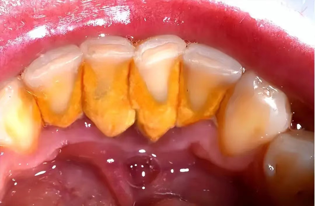 消除牙结石3个偏方轻松去除,5分钟快速去除牙结石