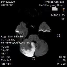 如何摆脱头晕眩晕的痛苦,眩晕一招搞定头晕