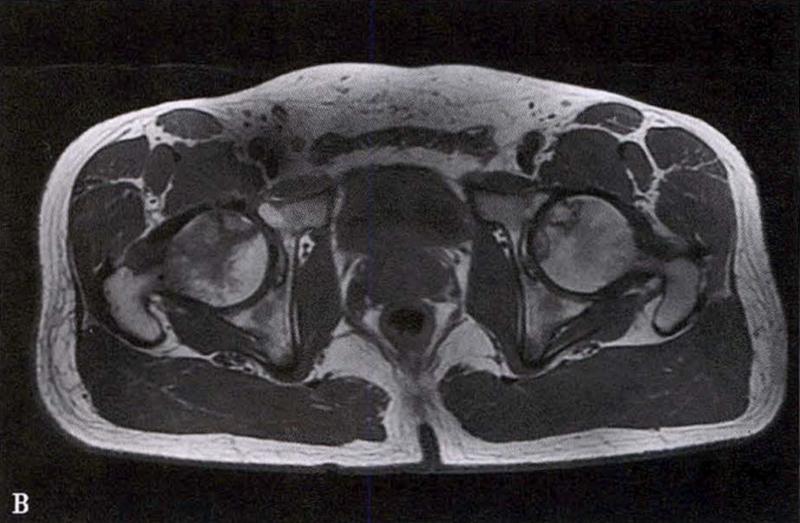 全国十大股骨头坏死诊疗中心,股骨头坏死诊疗方法有哪些