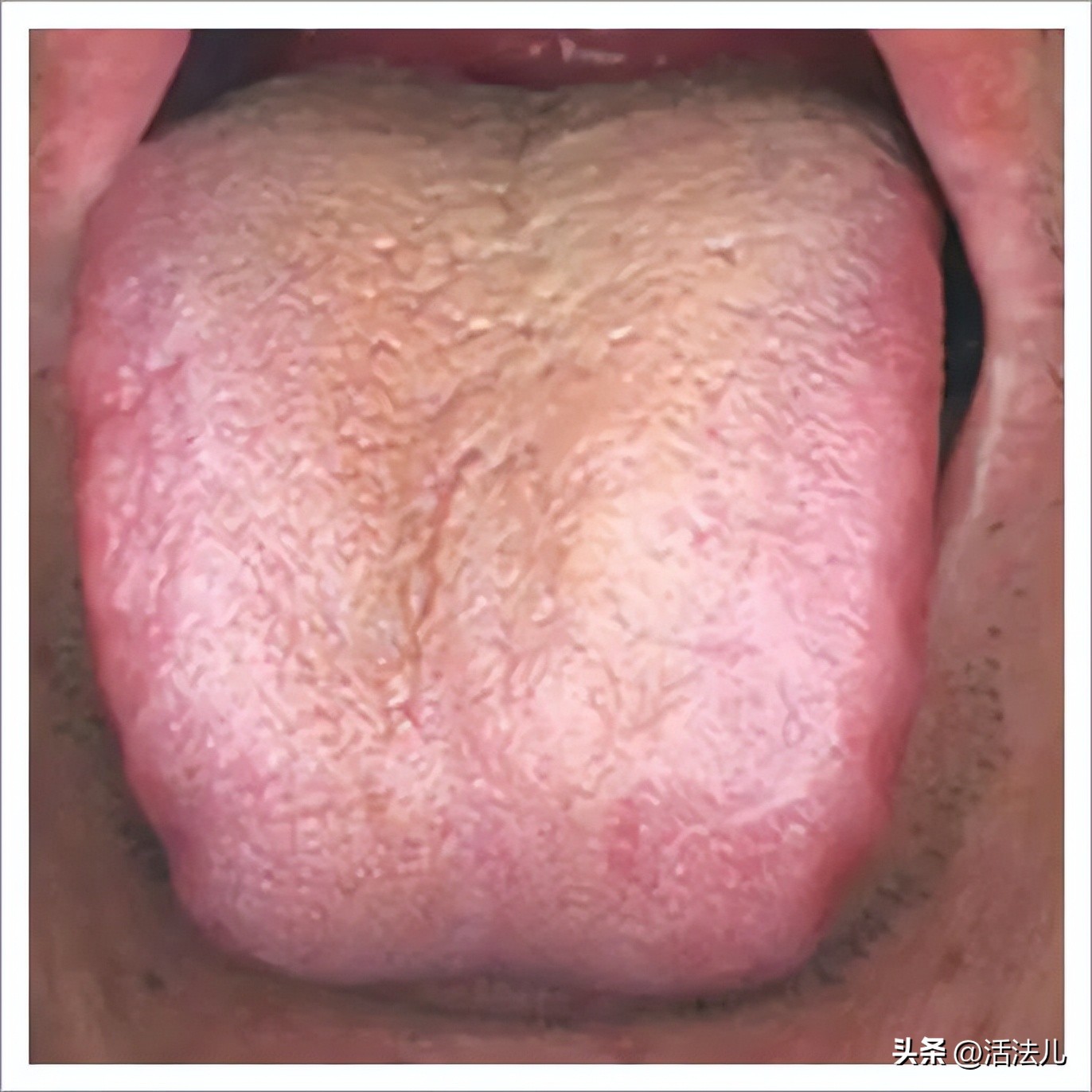 新冠专挑软柿子捏？60个阳性患者都有的3个共性，尤其是这3类人