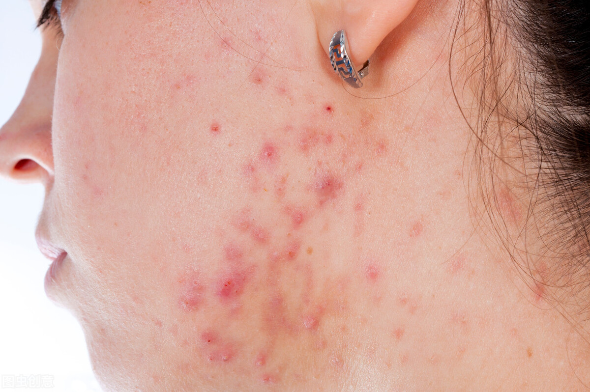 皮肤干燥会引起泛红吗,皮肤干燥会导致皮肤粗糙吗