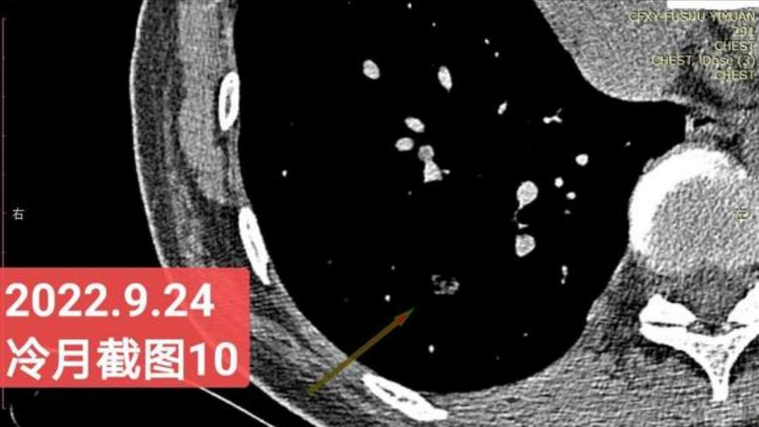 7mm肺结节恶性的怎么办,7mm实性肺结节危险程度
