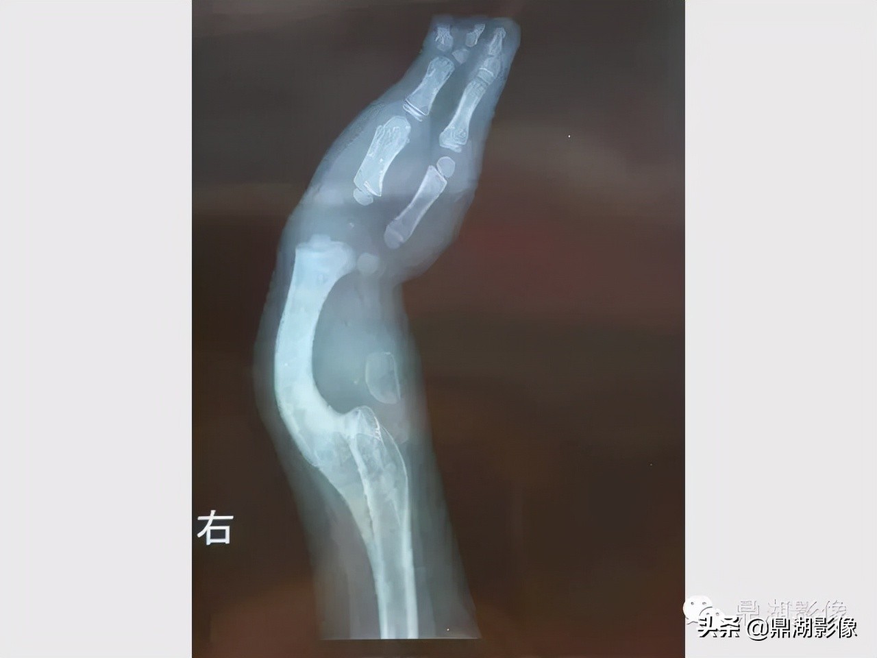 先天桡骨缺失畸形能治疗吗,先天性桡骨发育不良