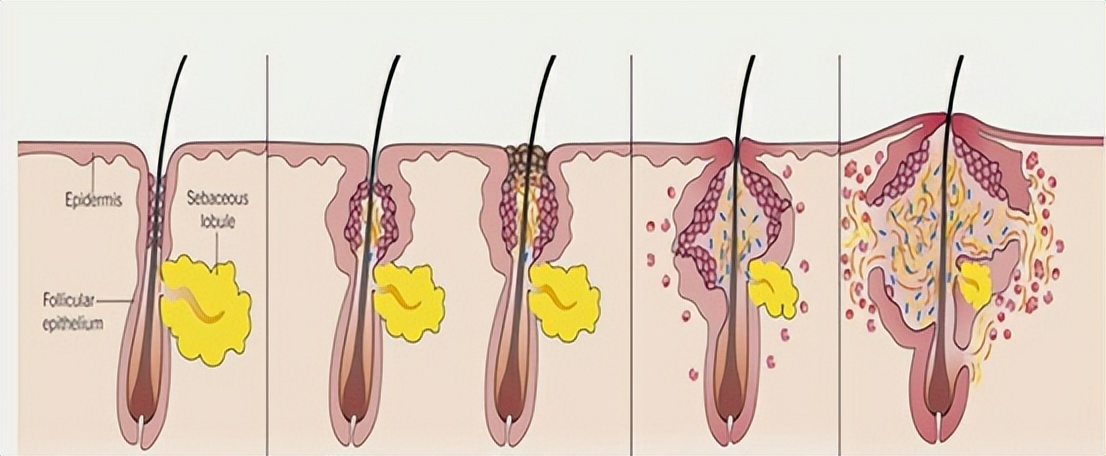 青春期男孩脸上满脸痘怎么处理 (青春期长痘要看皮肤科医生吗)