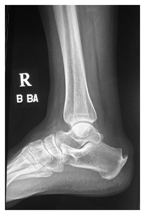 什么动作可以缓解走路足跟痛,经常走路脚疼如何减轻