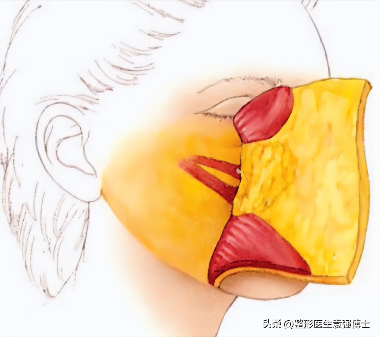 面部皮肤松弛形成口角囊袋,口角囊袋是皮肤松弛的结果吗