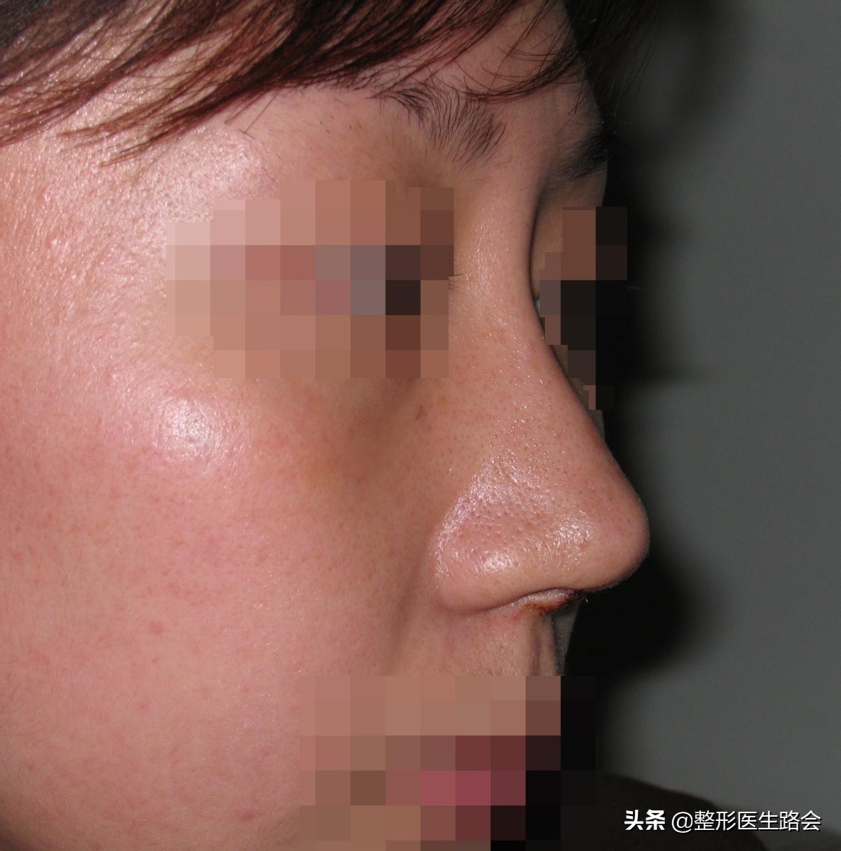 硅胶隆鼻5年歪了怎么修复,隆鼻10天歪了可以矫正吗