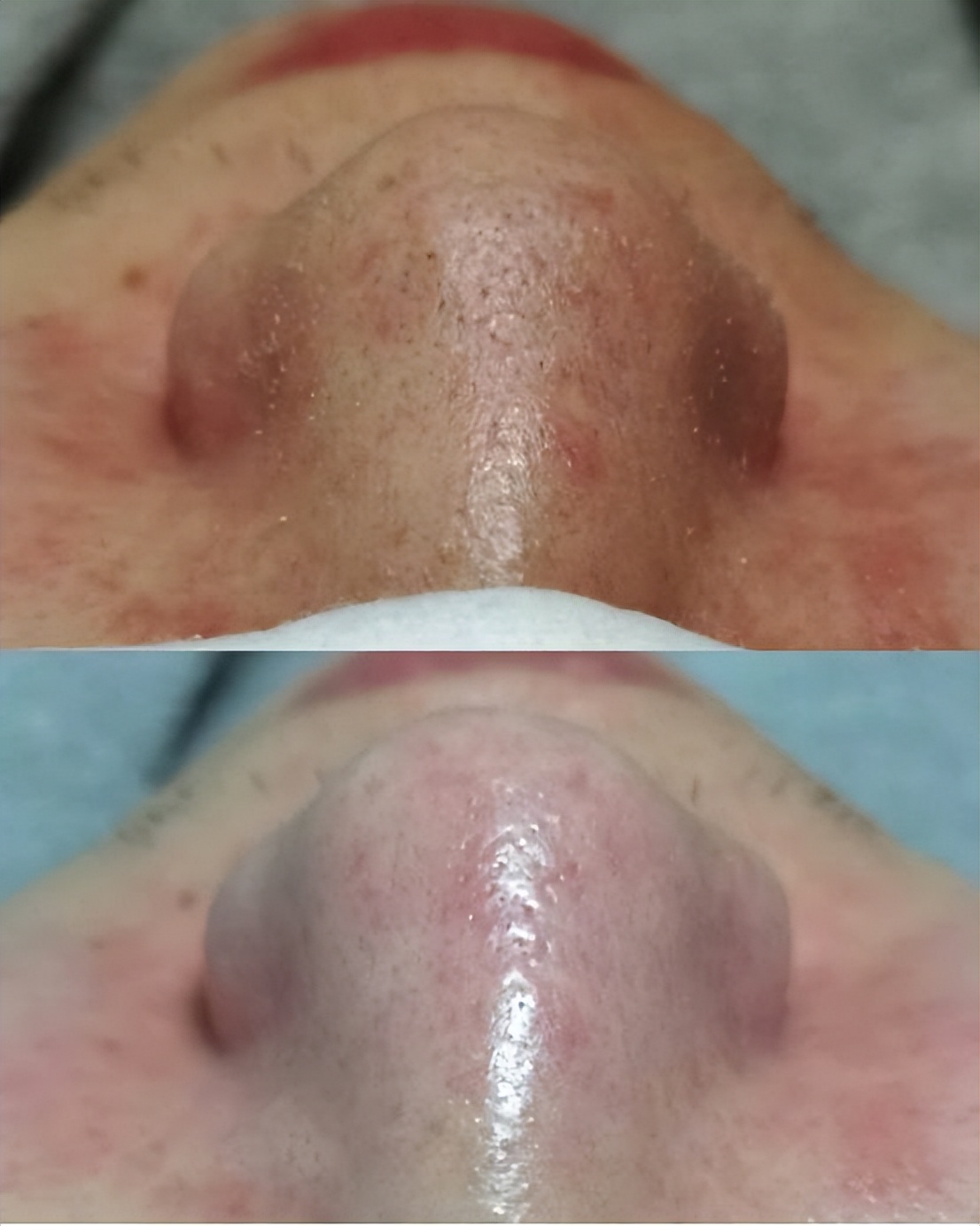 鼻子毛孔小黑头出不来怎么办,小女孩鼻子有黑头毛孔粗怎么办