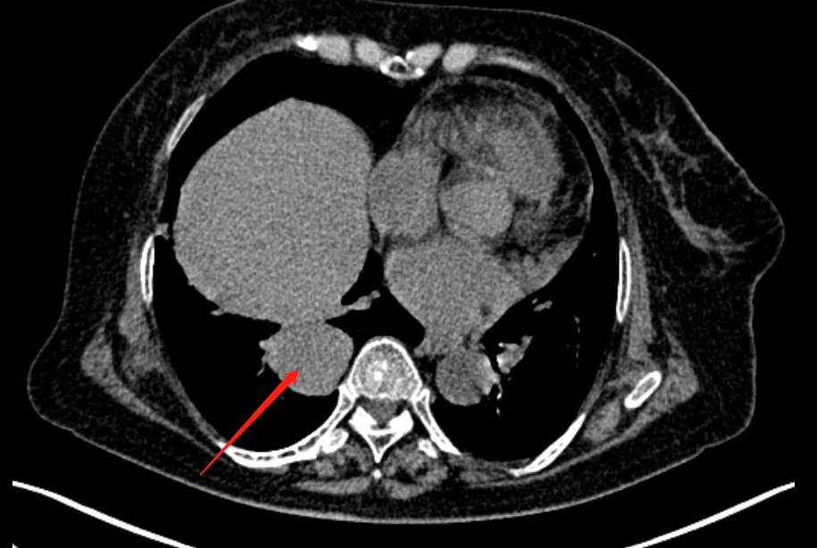 胸腺鳞状细胞癌手术后两年肺转移,胸腺鳞癌转移了能活多久