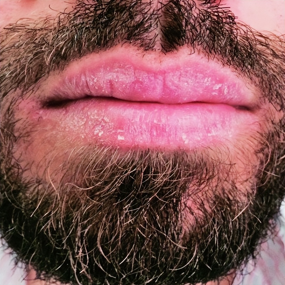 老舔嘴唇是什么病,成年人爱舔嘴唇是什么原因引起的