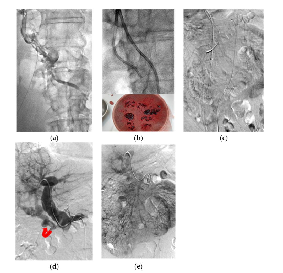 非肝硬化门静脉血栓,门静脉血栓溶栓治疗