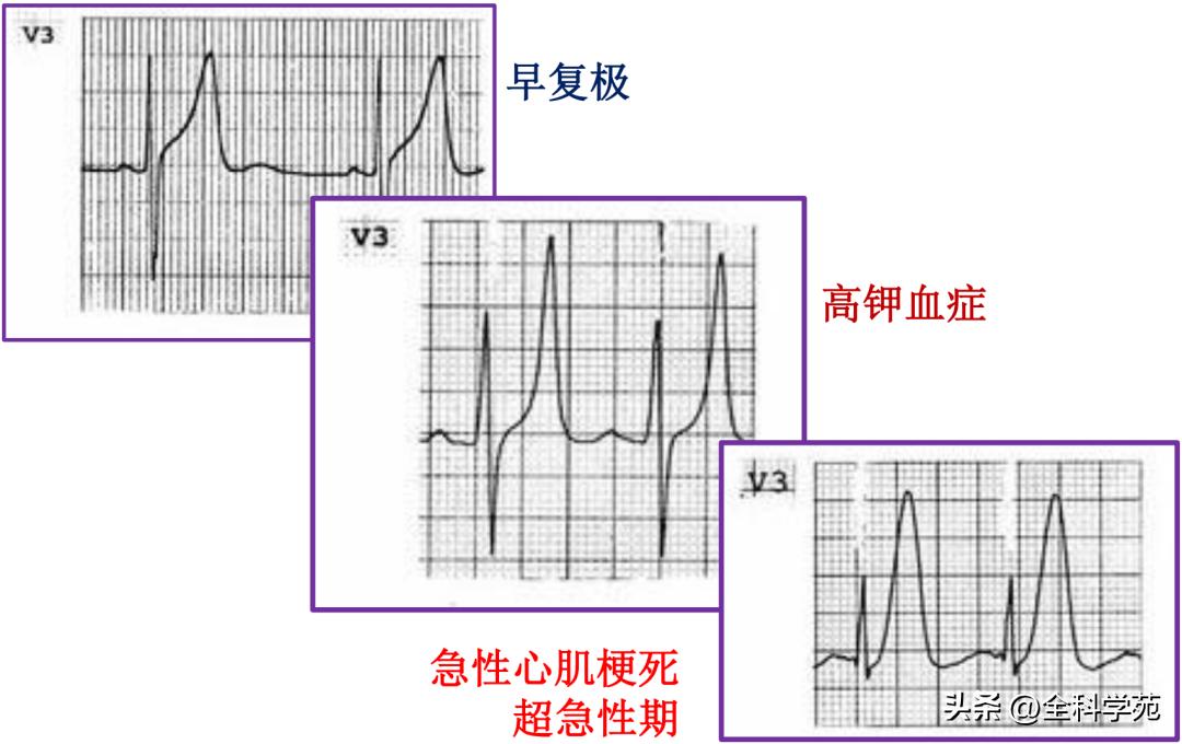 t波高尖心电图判断标准,t波高尖判断标准