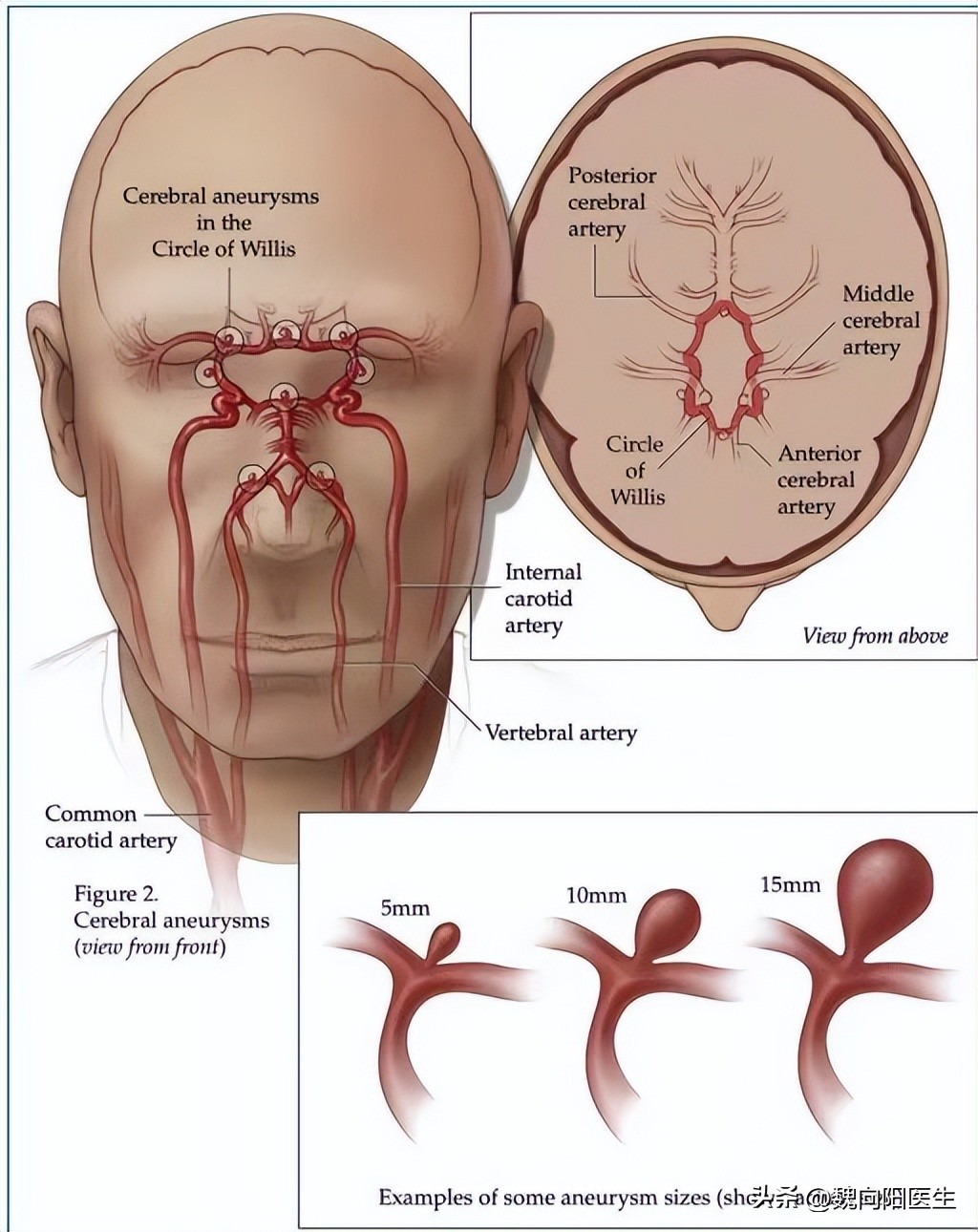 发现颅内动脉瘤究竟要不要手术,颅内动脉瘤是什么原因引起的