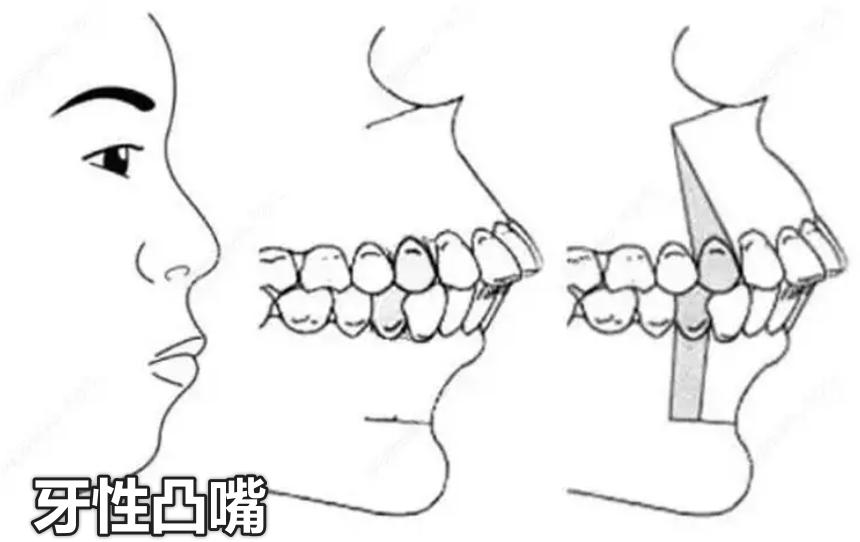 塌山根塌鼻梁怎么拯救,没山根塌鼻梁凸嘴怎么改善