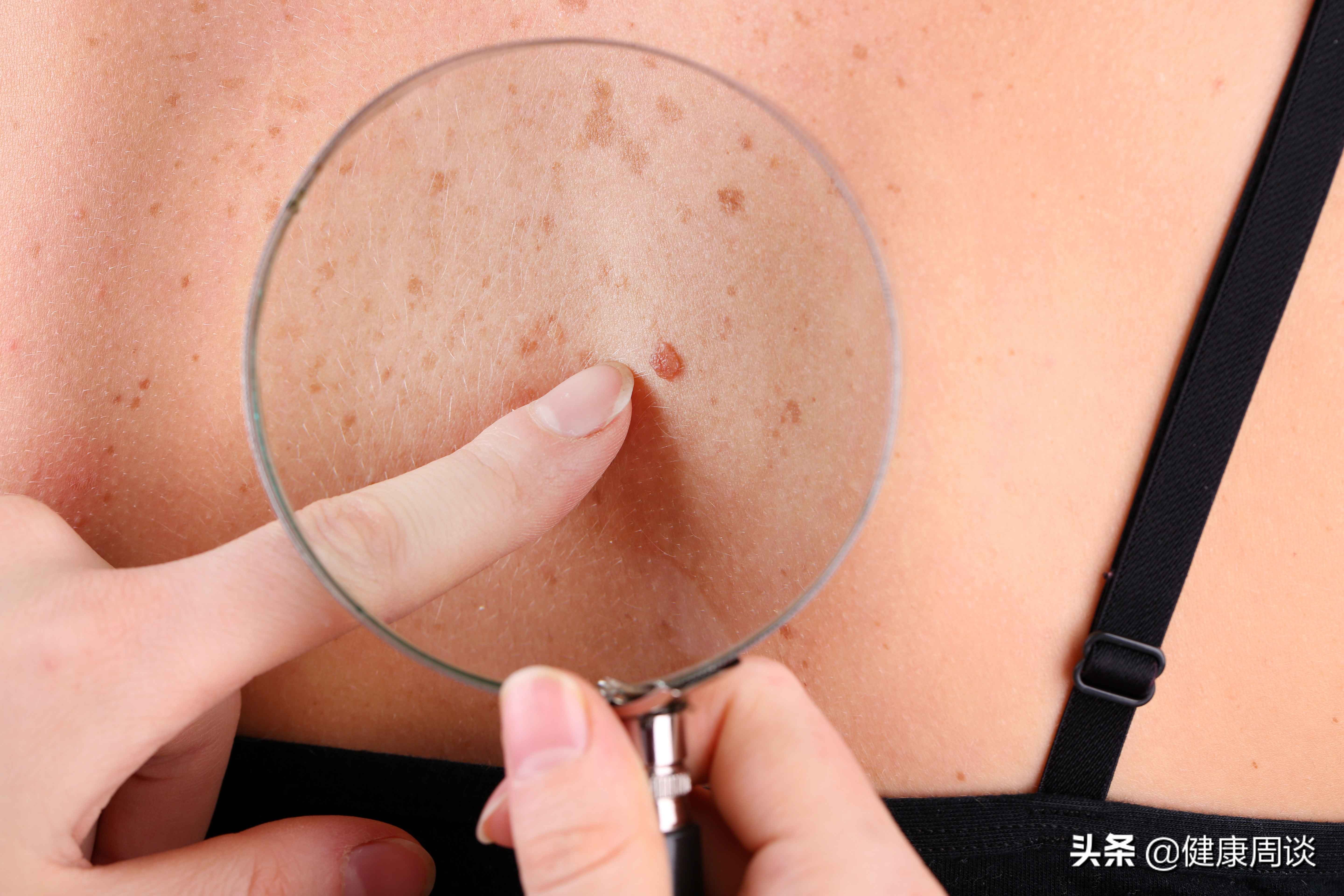 扁平疣很多简单有效的去除方法,扁平疣最不痛的去除方法