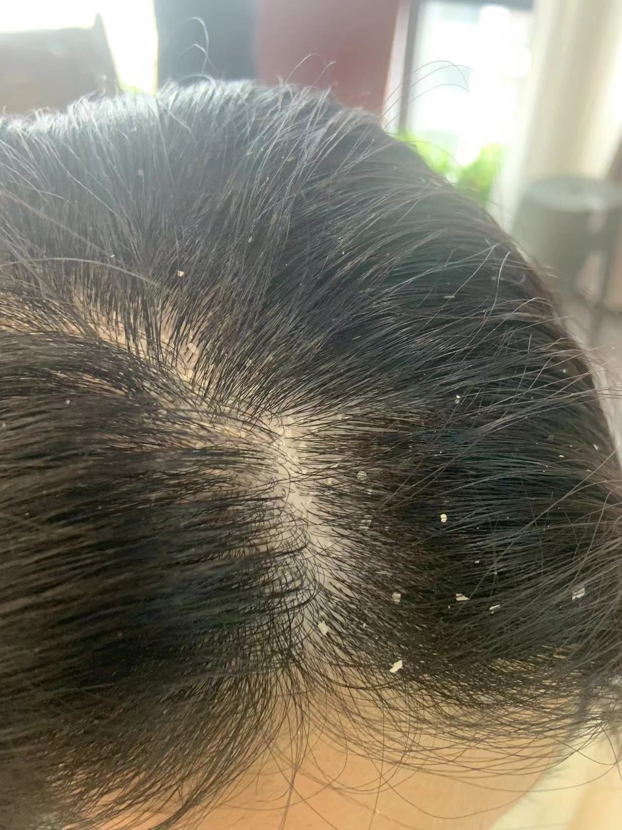 去除顽固头屑的洗发水推荐,治疗头屑用洗发水推荐哪款