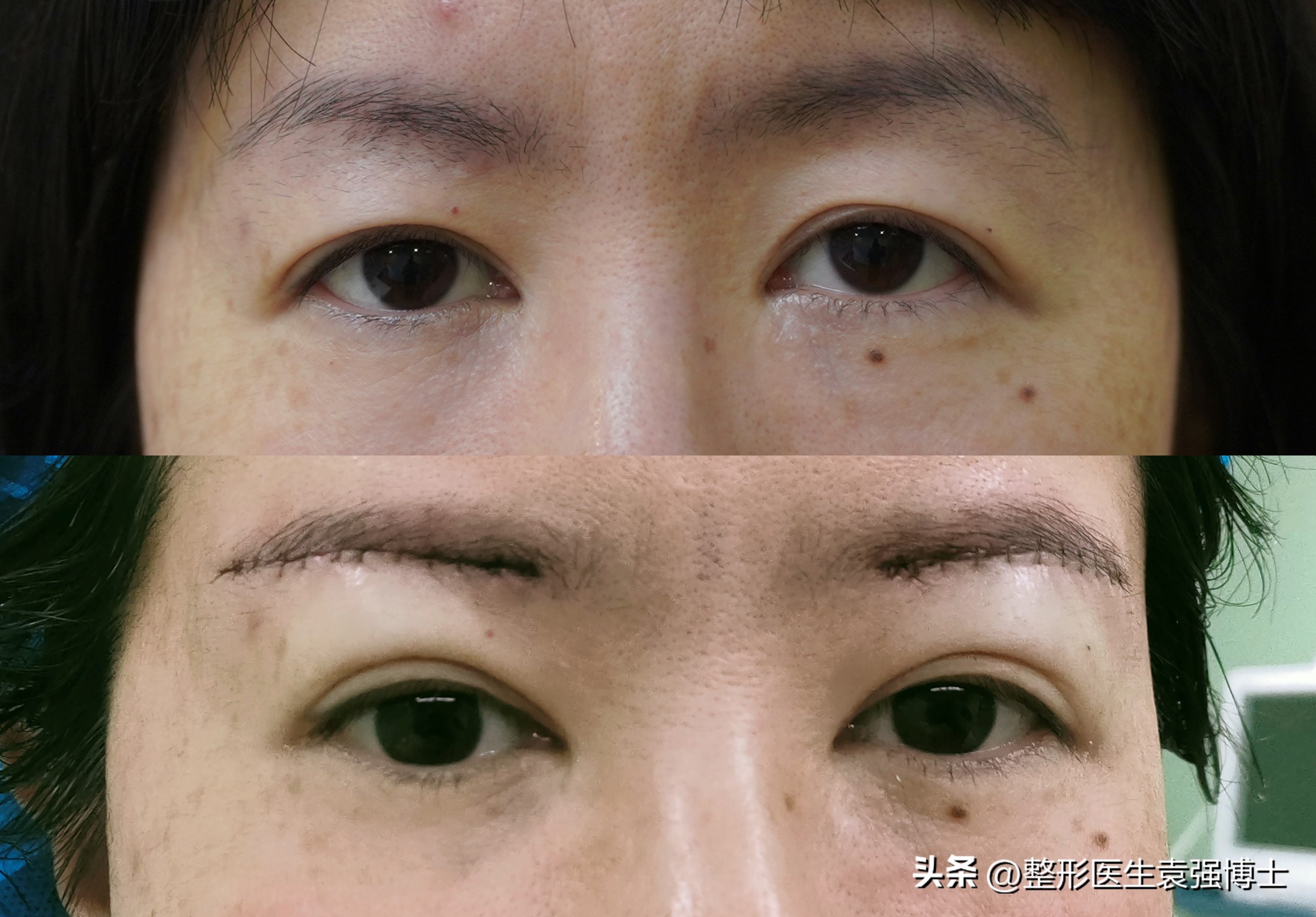 上眼皮松下垂该怎么办,上眼皮松弛耷拉怎么办