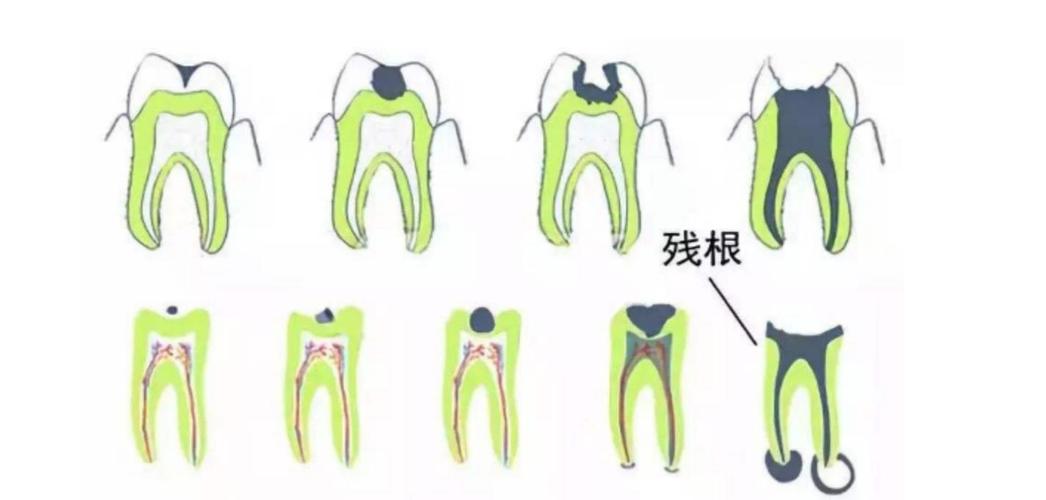 牙床有残根20多年了需要拔掉吗,牙只剩下残根了没法接需要拔掉吗