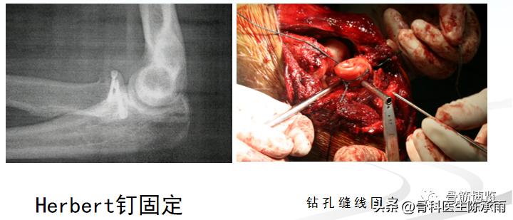 肘关节恐怖三联征最新治疗方法,肘关节恐怖三联征最佳治疗方法