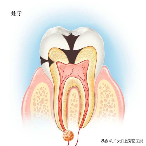 蛀牙烂空了怎么办只剩肉,蛀牙烂空了松动必须得拔掉吗