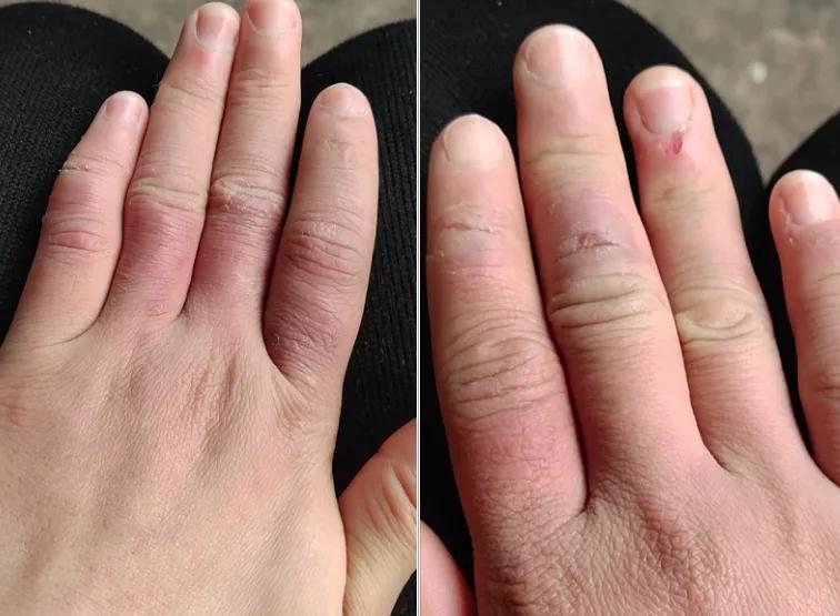 倪海厦当归四逆汤治冻疮,冻疮用四逆汤还是当归四逆汤