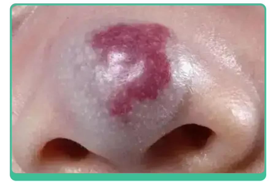 宝宝手上长胎记，一查竟是血管瘤！医生：这5种胎记要早处理