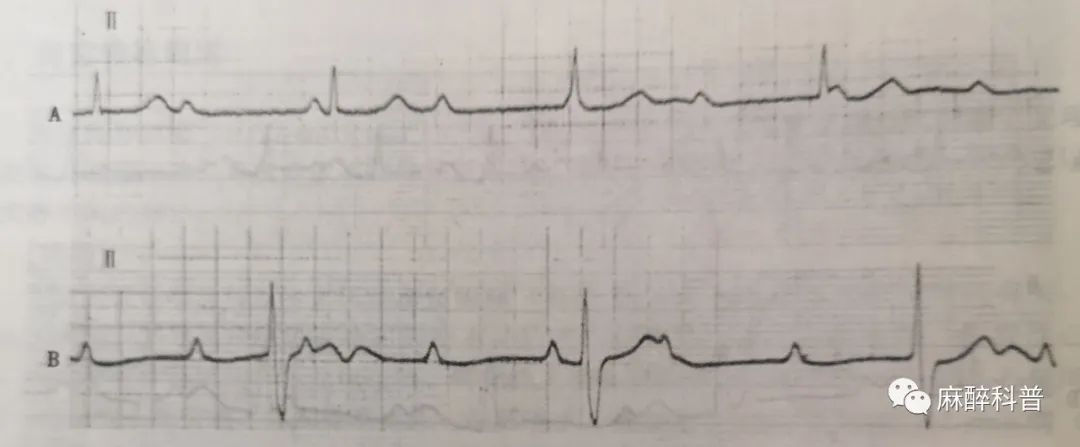 麻醉医生遇见三度房室传导阻滞怎么办？教你一招破解之术