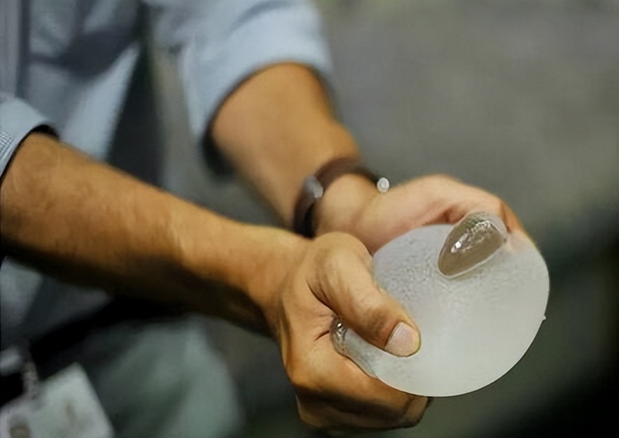 做了假体隆胸后需要祛疤吗,假体隆胸取出可以马上重新做吗