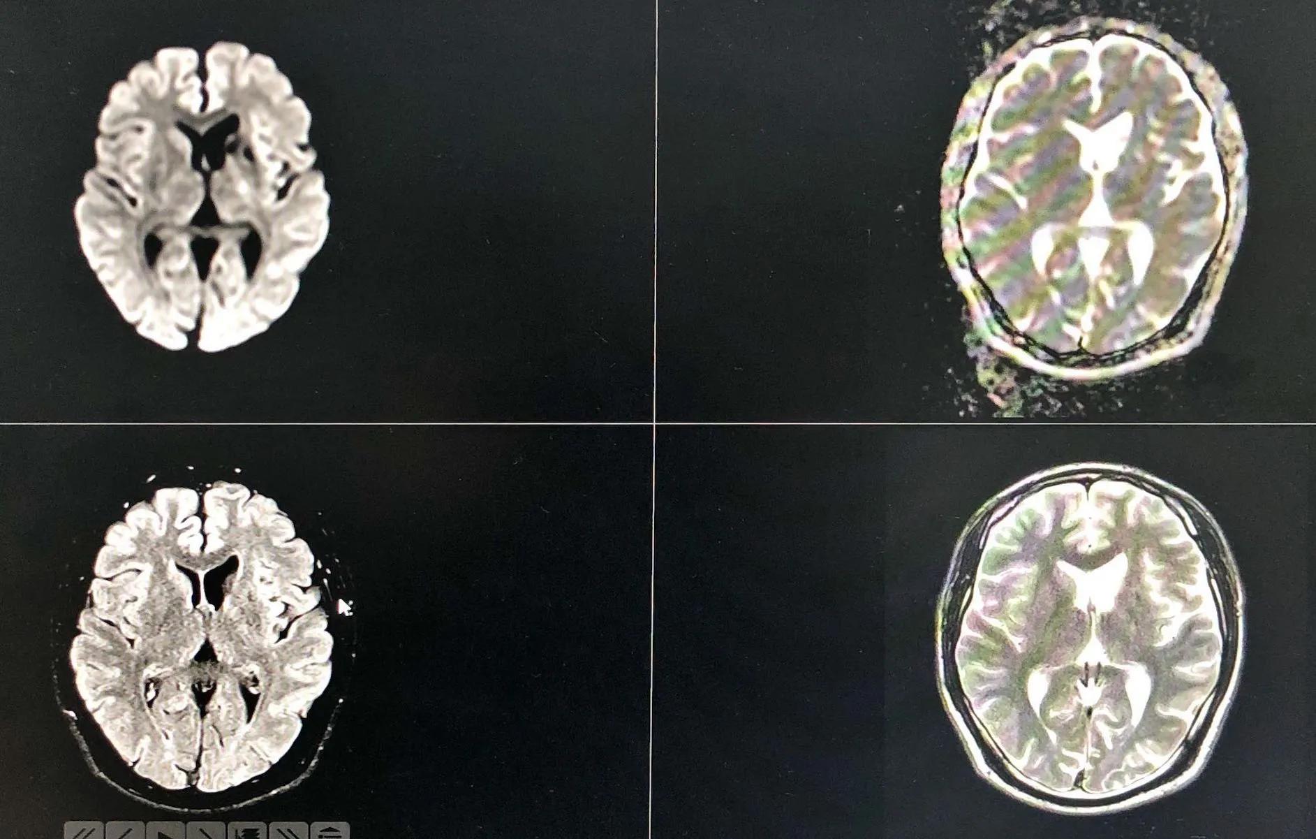 血管健康日为什么定在5月18日,血管的健康日