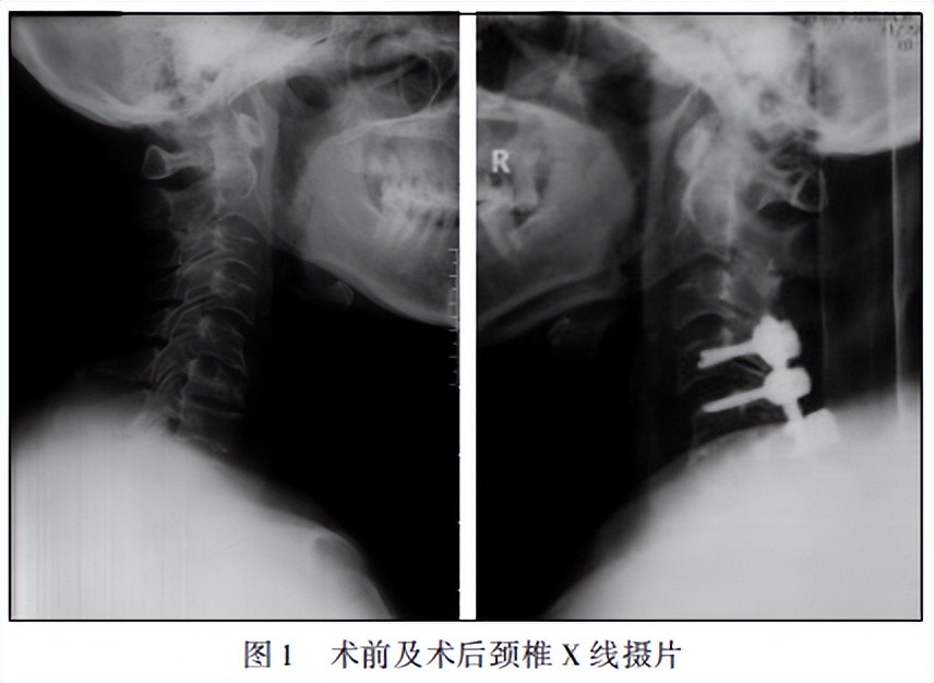 颈椎综合征的特征,颈椎综合征什么症状
