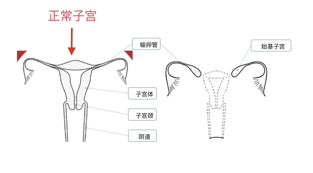 十七岁女孩被确诊,17岁女孩被诊断为石女