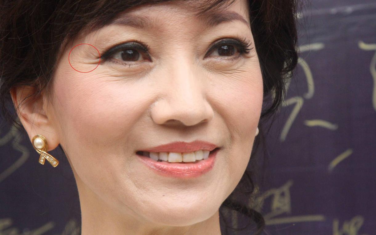 鱼尾纹是怎么引起的,什么叫鱼尾纹