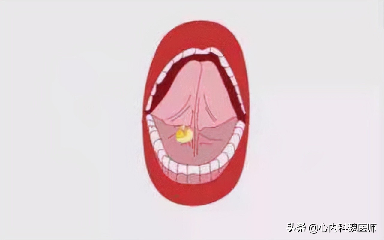 心肌缺血吃什么药效果更好,心肌缺血一般吃什么药可以缓解