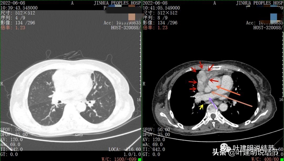 这位老乡，乏力来查，查出这么大个的纵隔肿瘤！会是什么呢？